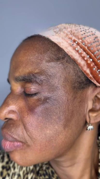 Hyperpigmentation, Melasma & Dark Spots Combo 6