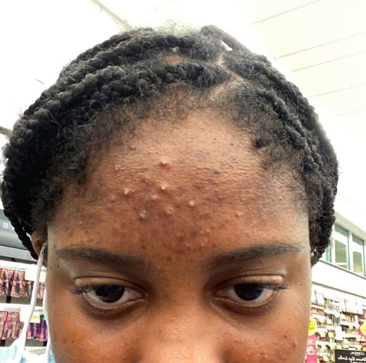 Acne, Breakouts & Pimples Combo 3