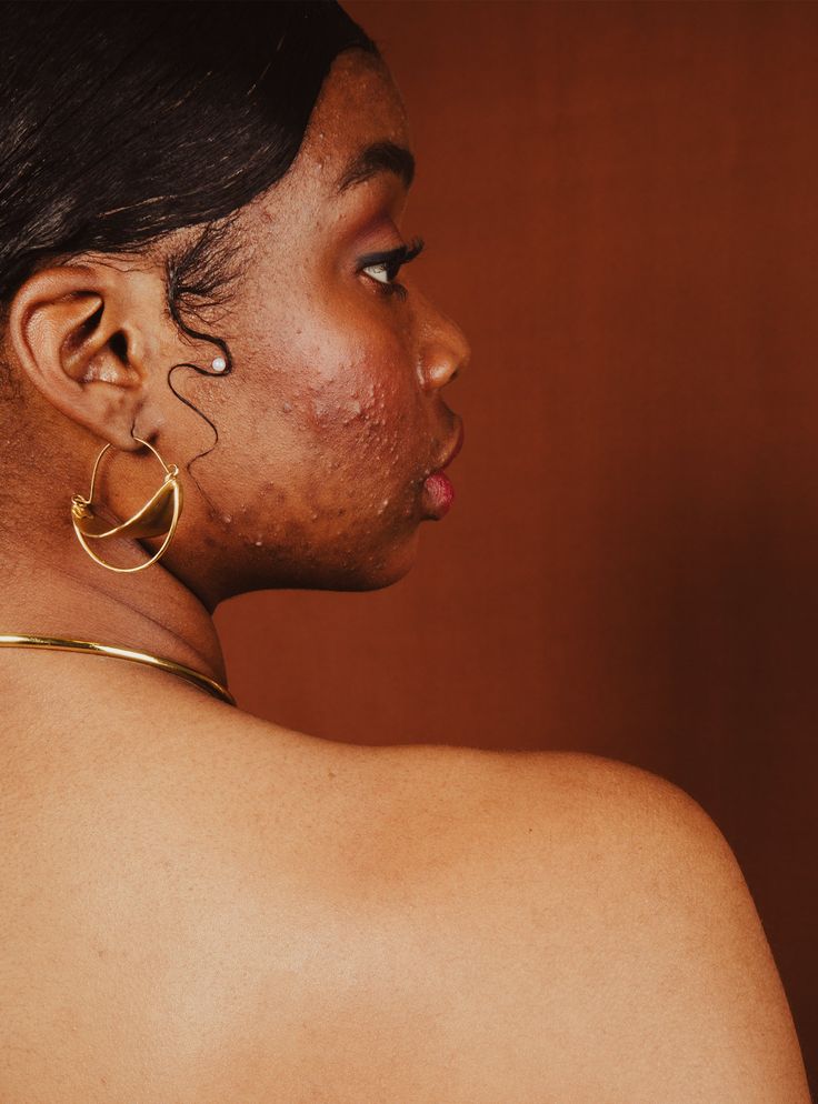 Acne, Breakouts & Pimples Combo 1