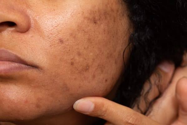 Hyperpigmentation, Melasma & Dark Spots Combo 2